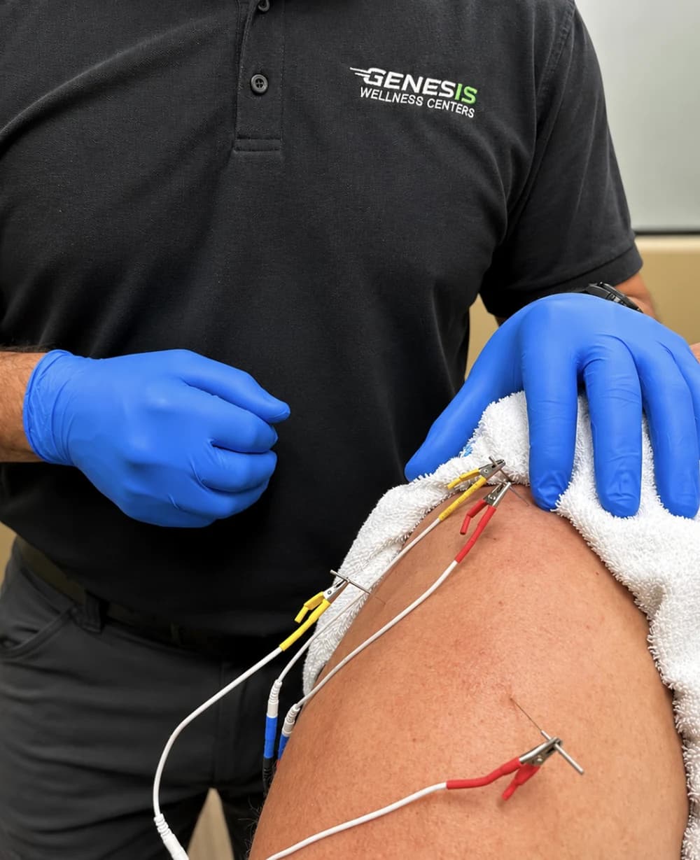 Dr. Clint Borman performing dry needling with electric stimulation on a patient's shoulder